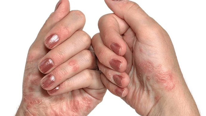 early stages of psoriasis
