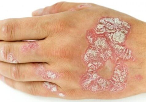 psoriasis on hands