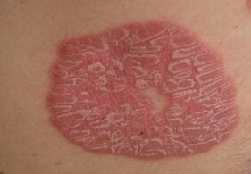 photo of psoriasis on the skin