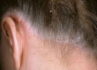 the cause of psoriasis on the head