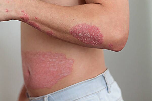 psoriasis on the body of men