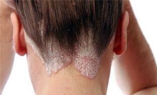 the forms and stages of the development of psoriasis
