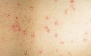 image of early stage psoriasis