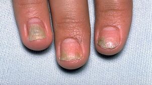 the cause of psoriasis on the nail